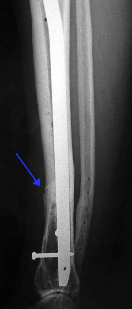 pseudoartrosis de tibia