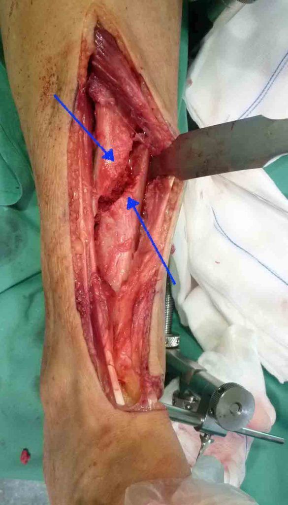 cirugía de pseudoartrosis de tibia