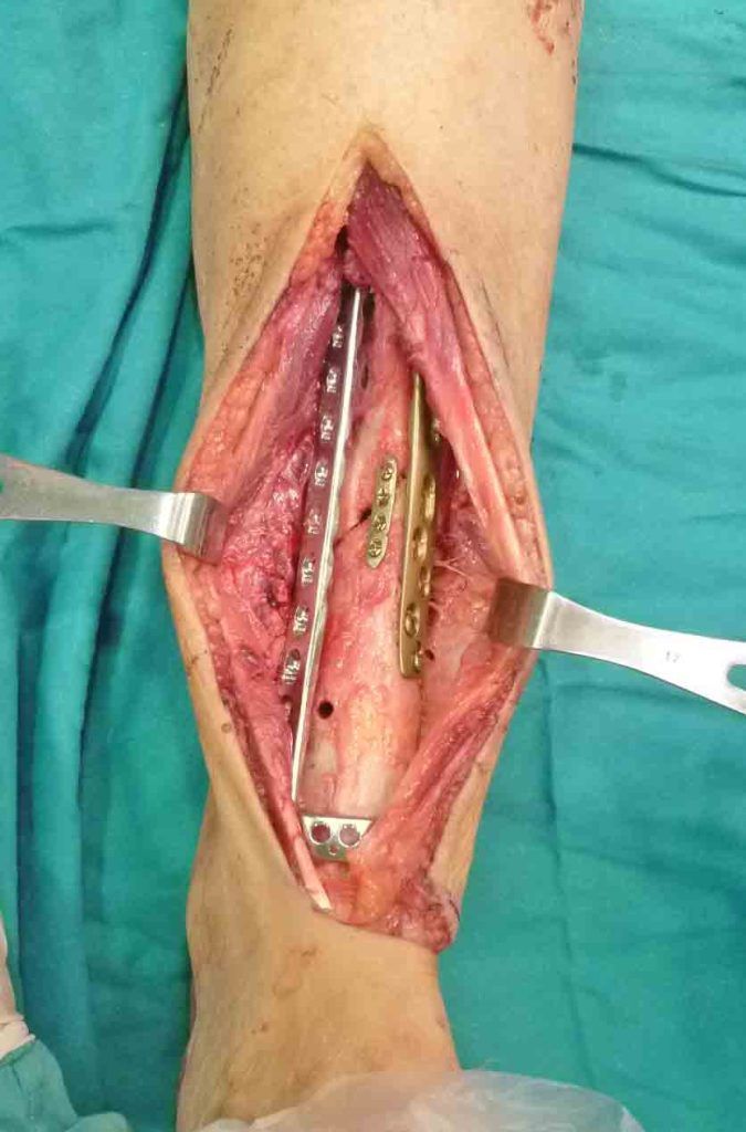 cirugía de pseudoartrosis de tibia