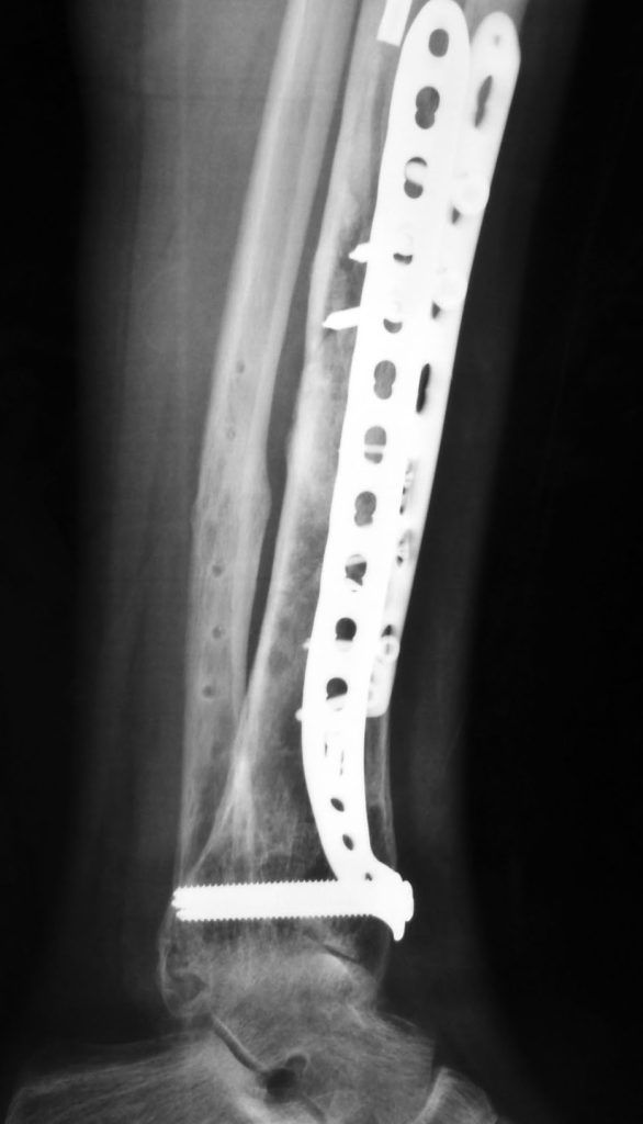 radiografía tras cirugía de pseudoartrosis de tibia