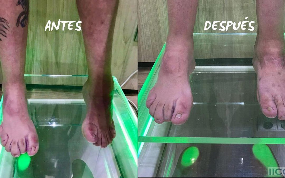 Nuestra Cirugía y sus Resultados en Pacientes con Charcot Marie Tooth