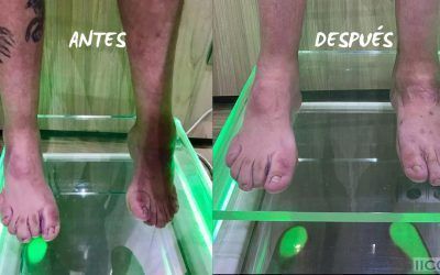 Nuestra Cirugía y sus Resultados en Pacientes con Charcot Marie Tooth