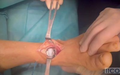 Prótesis de tobillo en pacientes mayores
