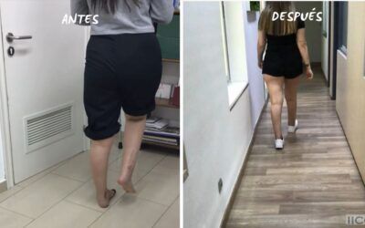 LESION OSTOCONDRAL EN FRACTURA DE PILÓN DERECHO (PARTE 2)