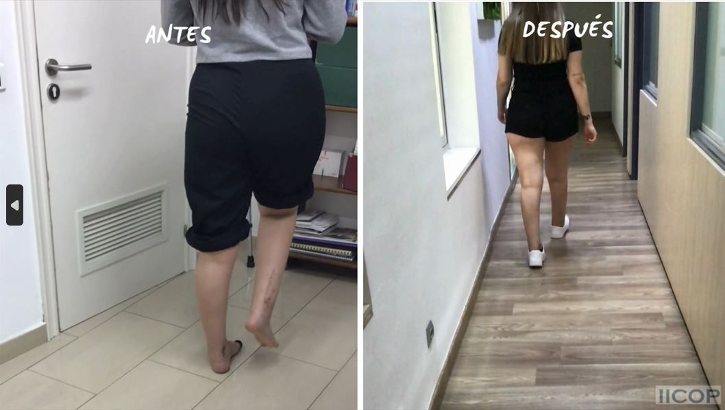 LESION OSTOCONDRAL EN FRACTURA DE PILÓN DERECHO