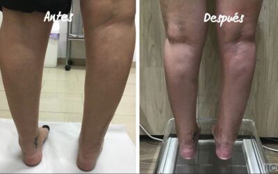 SECUELAS DE FRACTURAS EN AMBOS TOBILLOS (PARTE 1)