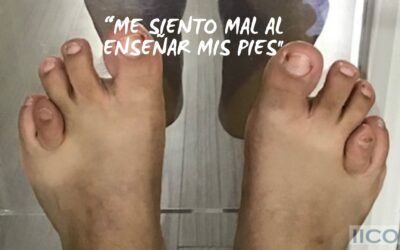 Braquimetatarsia – Me siento mal al enseñar mis pies