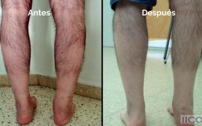Osteotomías de Tibia: Una Solución para Fracturas Diafisarias Mal Alineadas
