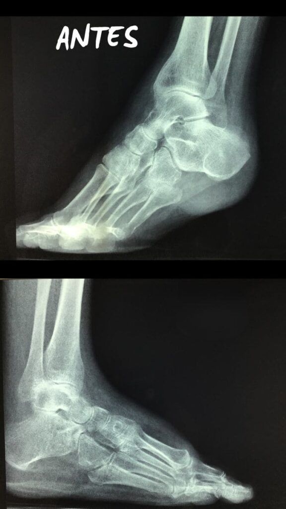 radiografia Polio en pie y tobillo