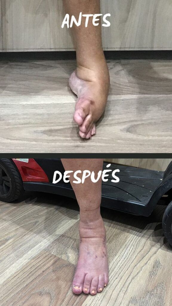 comparativa Polio en pie y tobillo