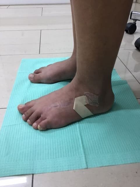 braquimetatarsia despues 3