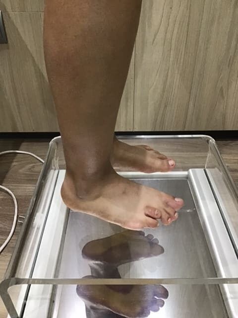 caso clinico braquimetatarsia 2
