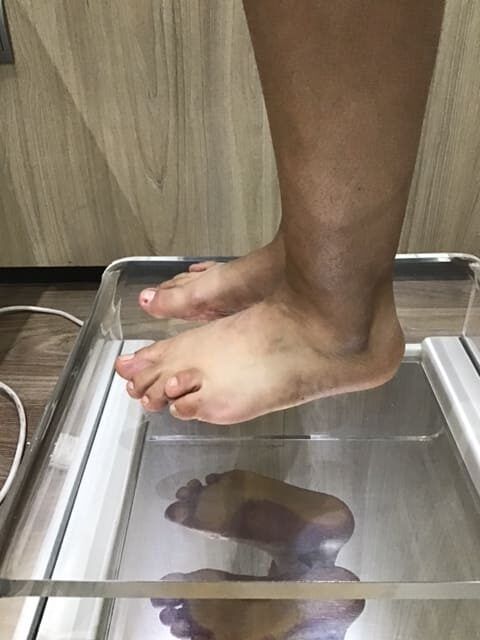 caso clinico braquimetatarsia