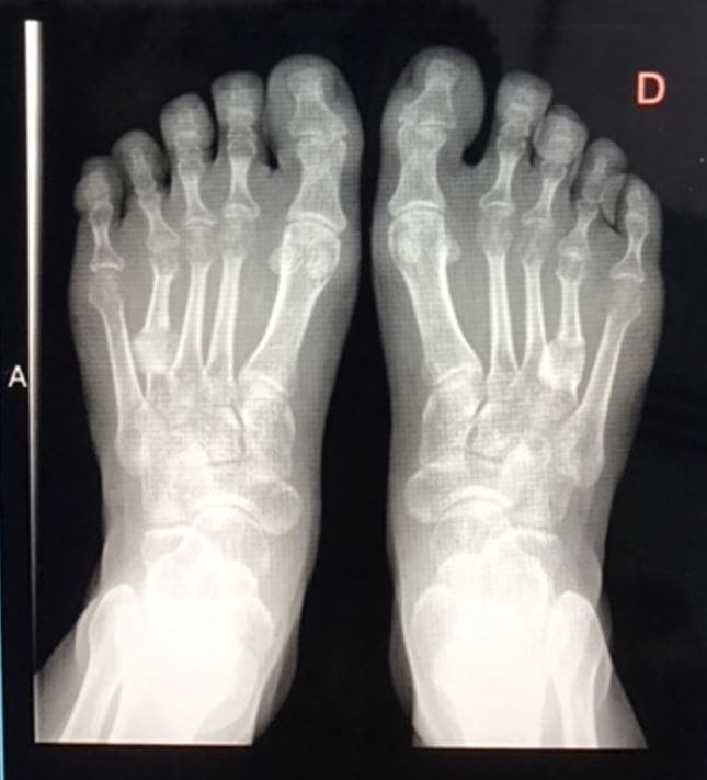 radiografía braquimetatarsia