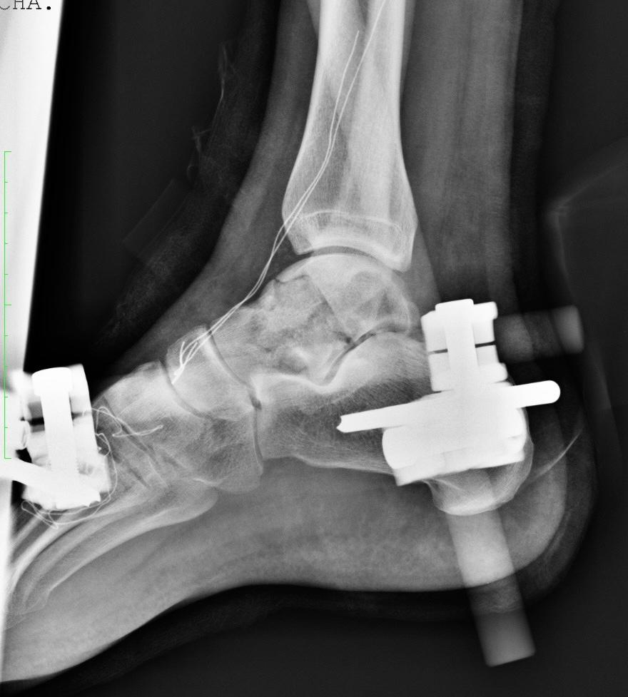 imagen 7 - Fractura de astrágalo