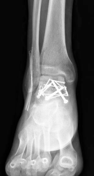 imagen 8 - Fractura de astrágalo
