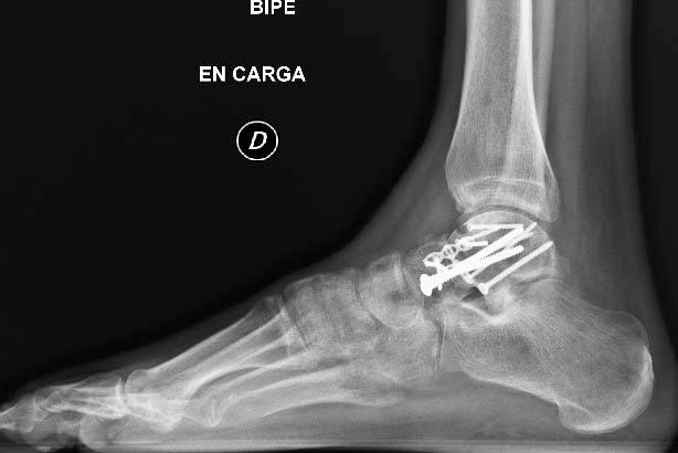 imagen 9 - Fractura de astrágalo