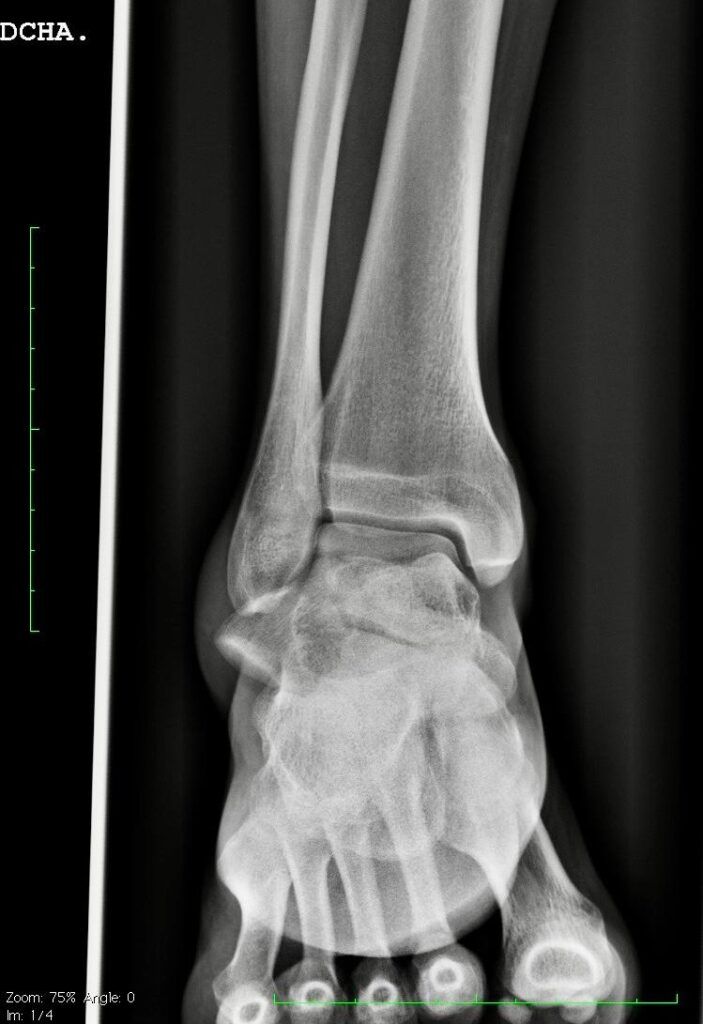 imagen 2 FRACTURA DE ASTRÁGALO