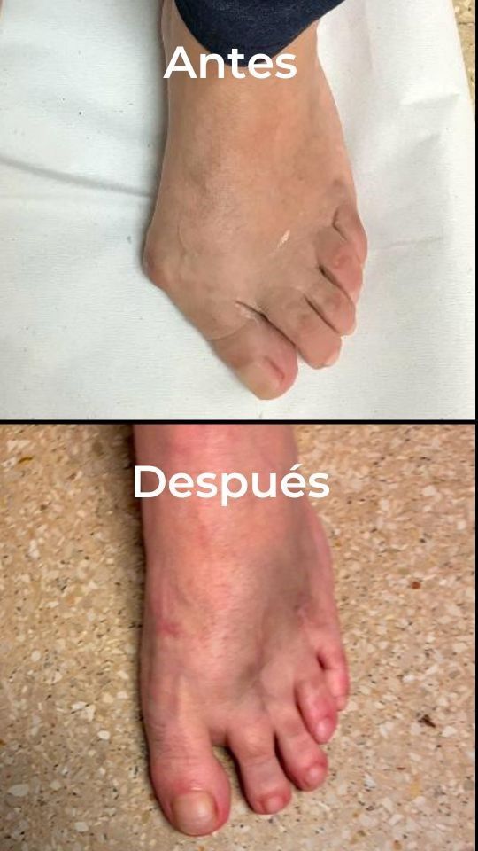 Cirugía de Hallux Valgus en Madrid