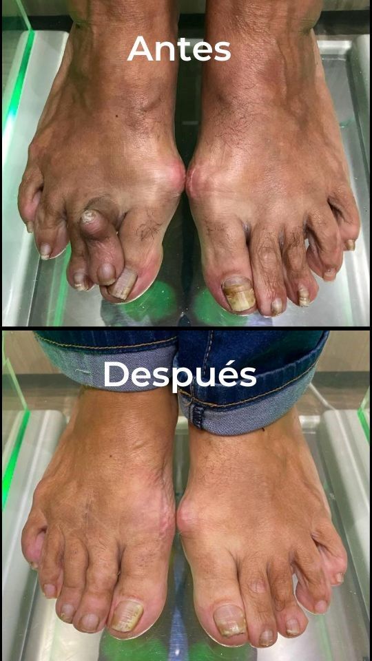 Cirugía de Hallux Valgus