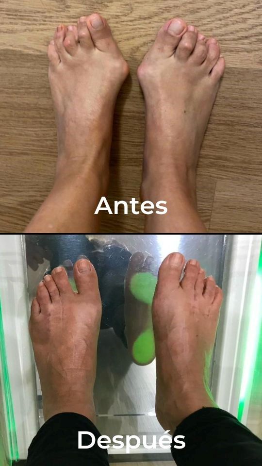 Cirugía de juanetes
