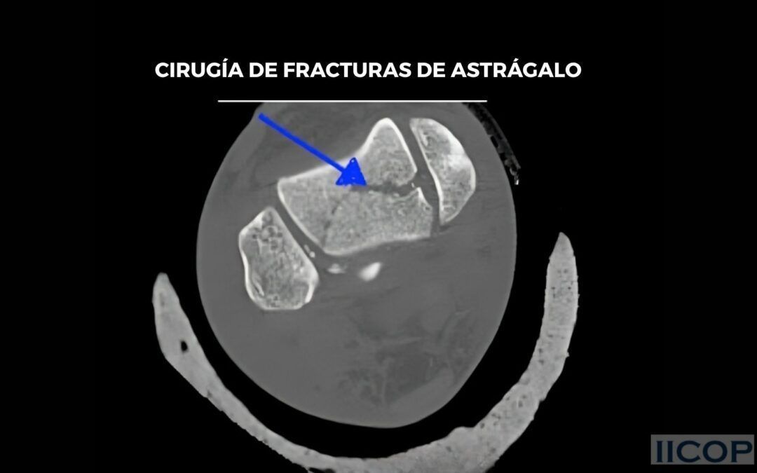 Cirugía de Fracturas de Astrágalo: donde especialización y resultado van de la mano