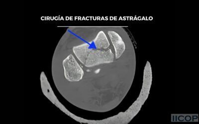 Cirugía de Fracturas de Astrágalo: donde especialización y resultado van de la mano