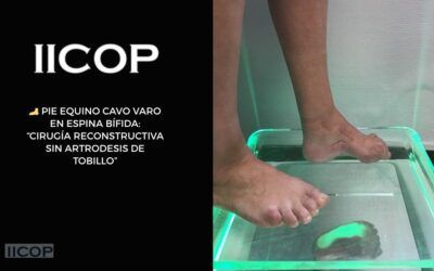 PIE EQUINO CAVO VARO en ESPINA BÍFIDA