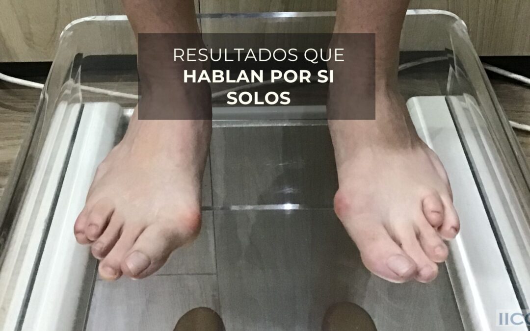 hallux valgus RESULTADOS QUE HABLAN POR SI SOLOS (Vídeo)