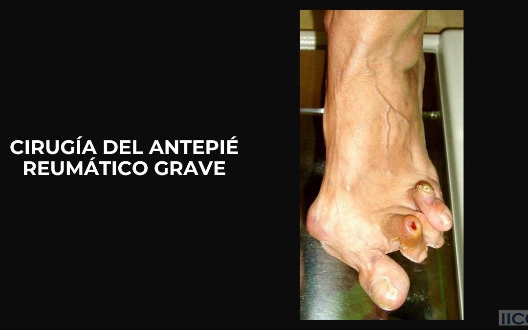 Cirugía del Antepié Reumático Grave