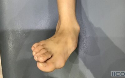 Así se transforma un pie plano con astrágalo vertical congénito